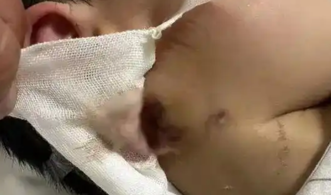 3岁男童被狗咬后18天离世
