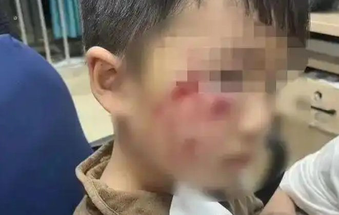 3岁男童被狗咬后18天离世